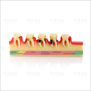 치주질환모형잇몸흡수 단계별모형/치주질환/잇몸염증/치아모형/환자설명용